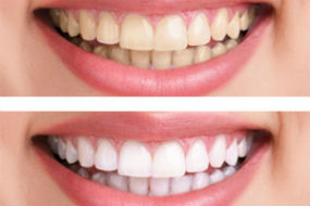 Teeth Whitening | Pampering Smiles | Camp Smiles, MD Dentist